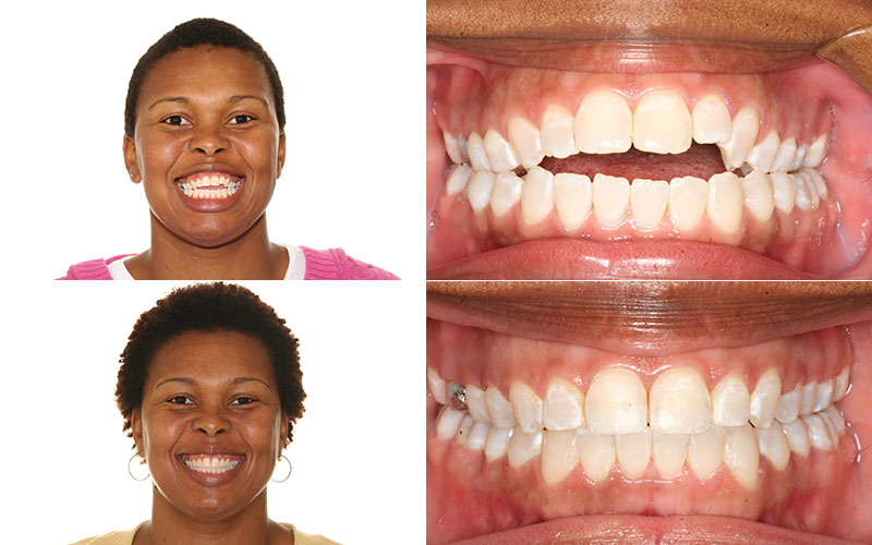 Open Bite Jaw Surgery & Braces Before and After Treatment