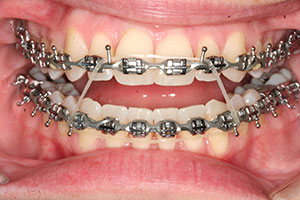 vertical elastics orthodontics