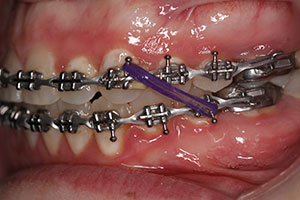 500pcs Dental Rubber Bands Orthodontic Gap Teeth Bands Braces