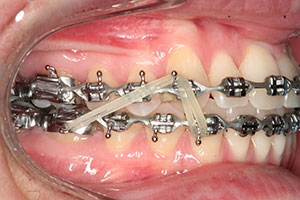 vertical elastics orthodontics