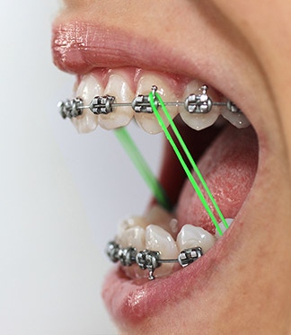 Using Rubber bans with Braces